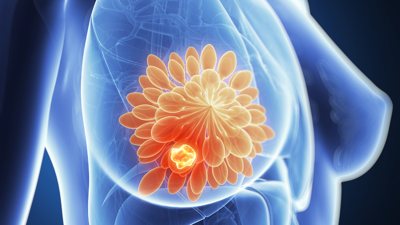 3d rendered illustration - breast cancer. Image Credit: Adobe Stock Images/Sebastian Kaulitzki